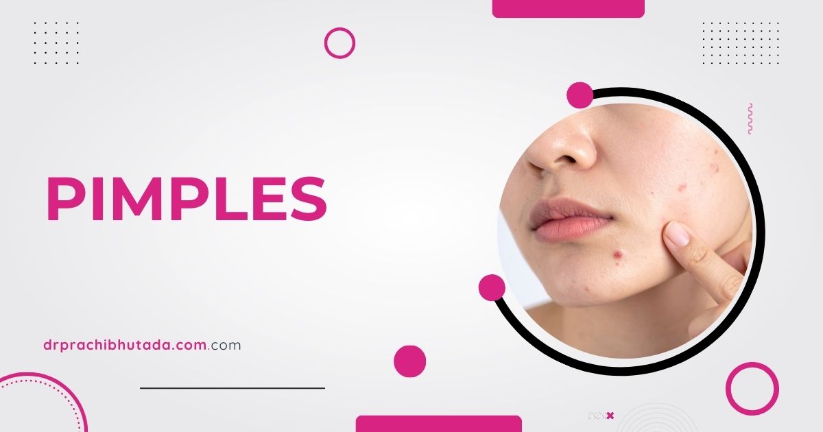 Ayuervedic Pimples Treatment in Nagpur