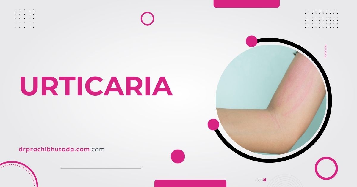 Ayurvedic Urticaria Treatment in Nagpur