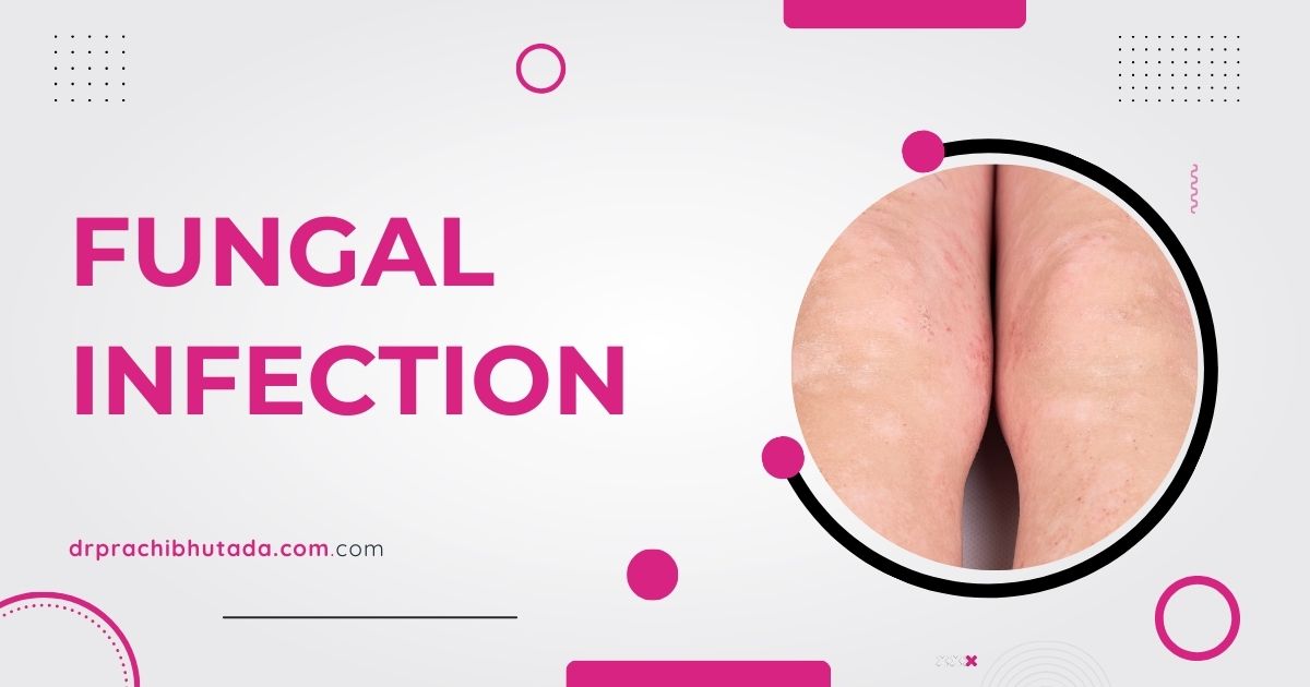 Ayurvedic Fungal Infection Treatment in Nagpur